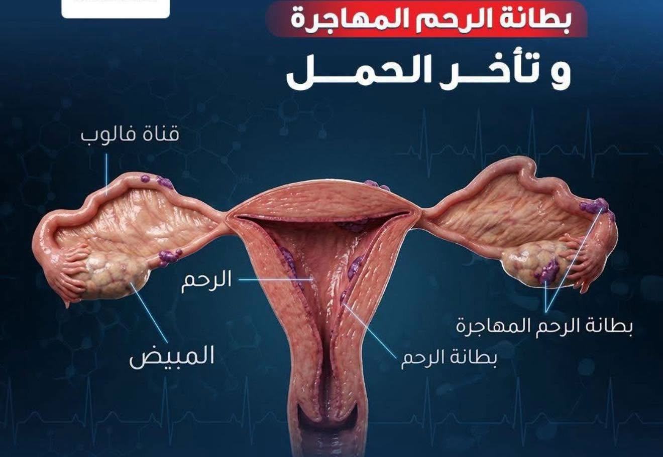 بطانة الرحم المهاجرة.. الأعراض والأسباب والعلاج وتأثيرها على الحمل